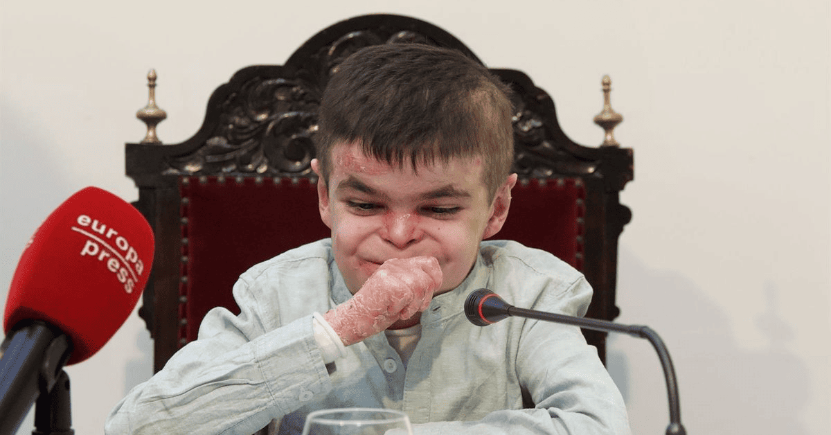 Leo, un niño de 12 años que padece la enfermedad de piel mariposa, siendo entrevistado por los medios de comunicación.